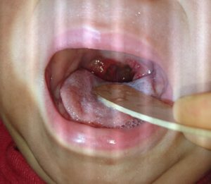口 口内炎 手足 病 手足口病で口内炎だけの場合はある？口の中だけや口の周りは？