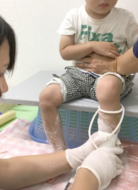 内反足装具作成の様子