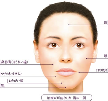 ヒアルロン酸注入